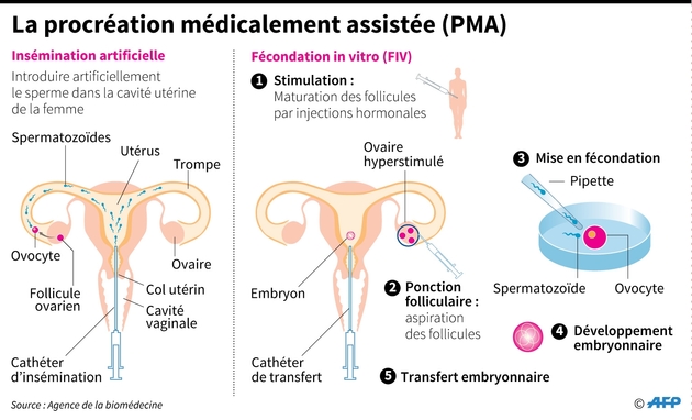 La procréation médicalement assistée