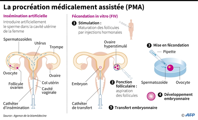 La procréation médicalement assistée